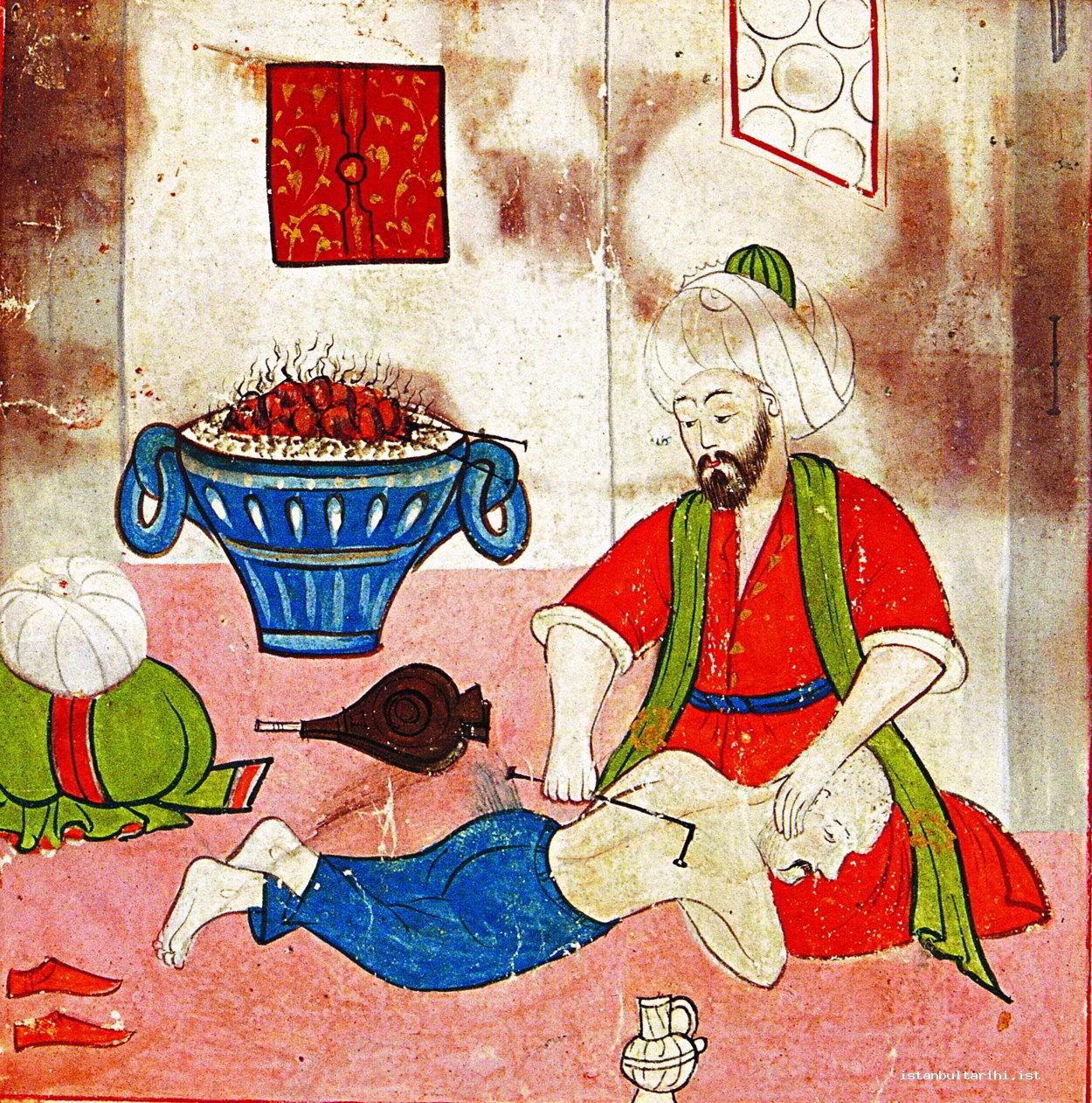 6- Treatment of a patient with back deformation and hump by cauterization (Sabuncuoğlu, Jarrahiyyat al-Haniya)    